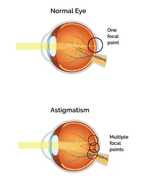 Diagram comparing a normal eye with one focal point and an astigmatism eye with multiple focal points