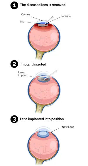 Infographic showing the three steps of cataract surgery: removal of the diseased lens, insertion of the implant, and implantation of the new lens.