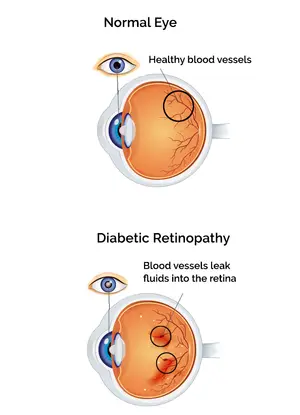 Normal eye shows healthy blood vessels, diabetic retinopathy shows blood vessels leaking fluids into the retina.