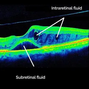 Optical coherence tomography image highlighting intraretinal and subretinal fluid accumulations.