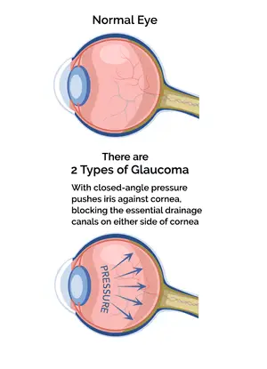 Diagram showing a normal eye compared to two types of glaucoma, illustrating the blockage of drainage canals in glaucoma