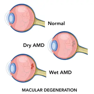 Illustration of normal, dry, and wet AMD in the eye, showing the progression from normal to advanced stages of macular degeneration.