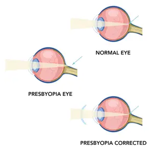 Illustration showing a normal eye, a presbyopia eye, and a presbyopia corrected eye