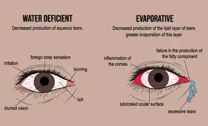 An illustration comparing Water Deficient and Evaporative dry eye syndromes, showing symptoms and causes.