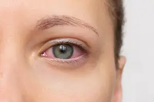 A close-up of a woman's eye with a slightly pinkish hue and a slight tear in the eye.