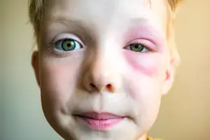 A close-up of a young boy with pink spots on his cheeks and green eyes