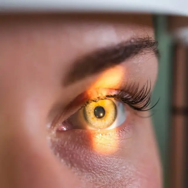 close up of a person's eye with a yellowish tint