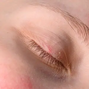 Close-up of a person's eye showing a red, inflamed area near the eyelid, possibly a stye or chalazion, with visible eyelashes and skin texture.