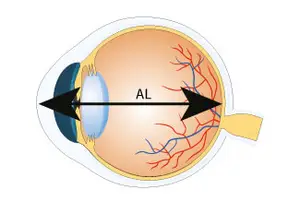 An image of the human eye showing its internal structure, with labels such as AL for the anterior lens.