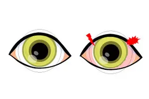 Illustration of a normal eye and an eye with a red spot on the cornea.