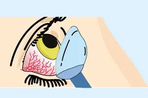 Illustration of a person's eye with a blue object resembling a medical tool, possibly a speculum, positioned against the lower eyelid.