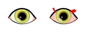 Illustration of a normal eye and an eye with red spots indicating inflammation.