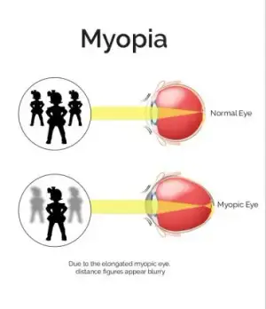 Illustration of Myopia, showing a normal eye and a myopic eye with a focus on how distance figures appear blurry due to an elongated myopic eye.