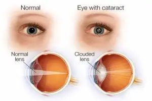 An illustration showing a normal eye compared to an eye with a cataract, highlighting the difference in lens clarity.