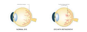 Normal eye and eye with retinopathy