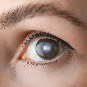 Close-up of a person's eye with a blue contact lens in the middle of the iris.