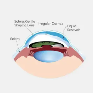 Diagram of the human eye showing the sclera, irregular cornea, liquid reservoir, and scleral gentle shaping lens.