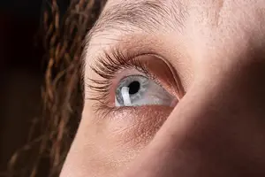 Close-up of a woman's eye with Kerotoconus