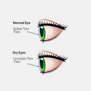 Illustration comparing a normal eye with stable tear film and a dry eye with unstable tear film.