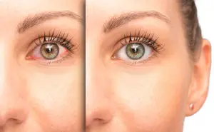 Woman's face before and after treatment for under-eye dark circles