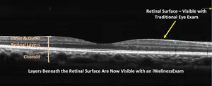 Diagram showing the difference between a traditional eye exam and an iWellnessExam, highlighting the visibility of inner retinal layers and the choroid with the latter.