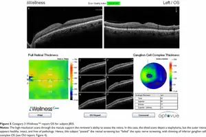A medical report image showing various retinal scans and thickness measurements for a patient identified as subject J835, including a color map of retinal thickness and a table of ganglion cell complex thickness measurements.