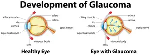 Illustration showing the development of glaucoma in an eye.