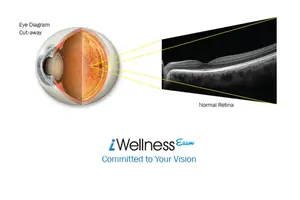 An eye diagram showing a normal retina with a cut-away view of the eye and a close-up of the retina.