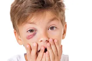 A young boy with a black eye on his right eye seems to be scared with his hands covering his mouth