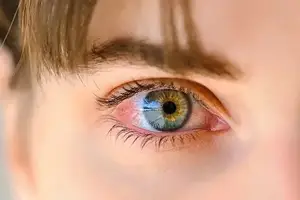 Close-up of a child's eye with noticeable redness and inflammation in the iris and sclera, reflecting light in a soft-focus background.