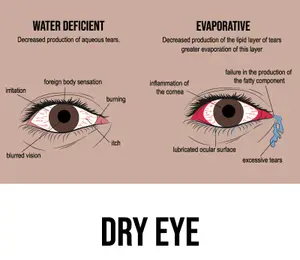 Infographic showing the causes and symptoms of dry eye, divided into two sections: water deficient and evaporative.