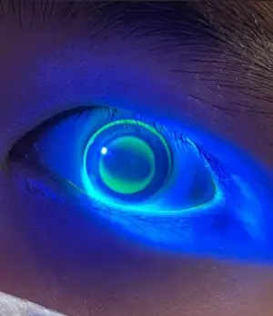 Close-up of a child's eye with a blue light illuminating the iris and pupil