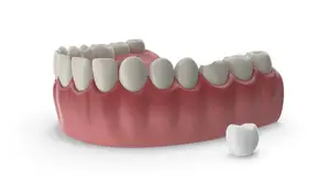 3D model of a dental implant with a crown on a white background