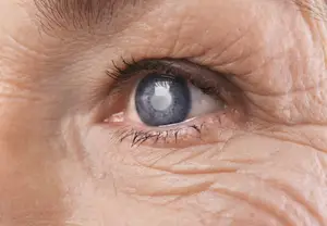 Closeup of an elderly person's eye with visible cataracts