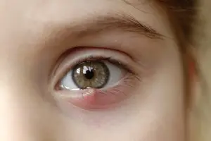 A close-up of a child's eye with a red spot on the eyelid.