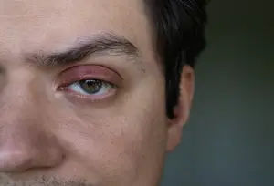 Close-up of a male face with a red eye from conjunctivitis
