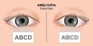 An illustration showing the comparison between normal vision and amblyopia in the eyes with labels ABCDE