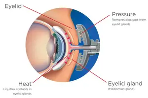 Illustration showing how the eyelid functions to remove blockage from the eyelid gland and how heat and pressure aid in this process.