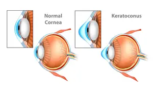 Illustration of a normal cornea versus a cornea affected by keratoconus.