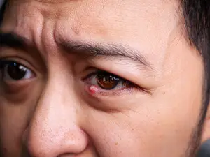 Close up of a man's face with a red bump under his right eye.
