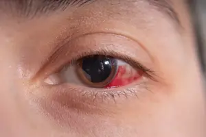 A close-up of a person's eye with a red spot in the white part of the eye, the eyelashes are long and brown, and the iris is black with a red spot on it.