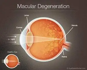 Diagram of macular degeneration in an eye, showing a healthy eye and an eye with degeneration.