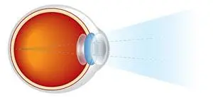 Illustration of a human eye with a beam of light entering and focusing on the retina