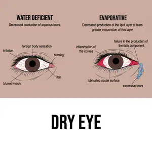 Diagram of dry eye symptoms and causes, including water deficient and evaporative types
