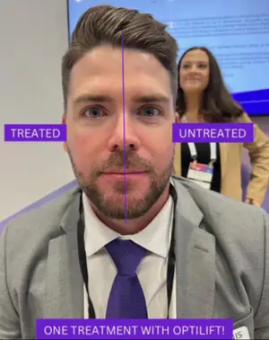A man's face is split into two halves, with one side labeled 'TREATED' and the other 'UNTREATED', showing the difference after one treatment with OptiLift.