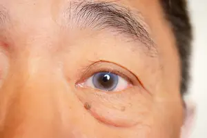 A close-up of a man's face with a mole near his eye and a freckle on his cheek