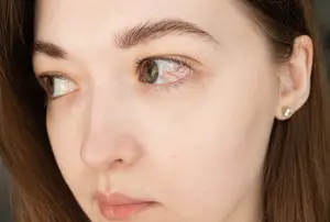 A close-up view of a woman's face with brown eyes and red veins in her eye