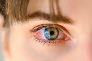Close-up of a young person's eye with a green iris and red sclera, looking to the left, with brown hair and eyelashes.