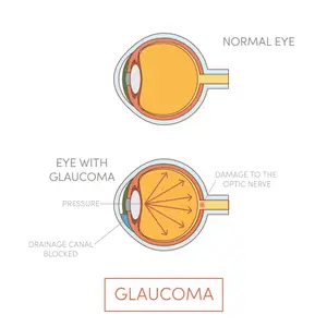 Diagram showing a normal eye and an eye with glaucoma
