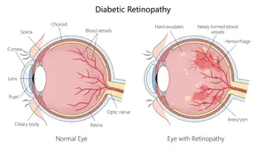 Diagram showing a normal eye and an eye with diabetic retinopathy